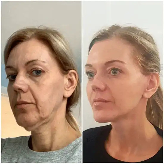 Benefits of Consulting a Board-Certified Breast Augmentation Surgeon in Dubai