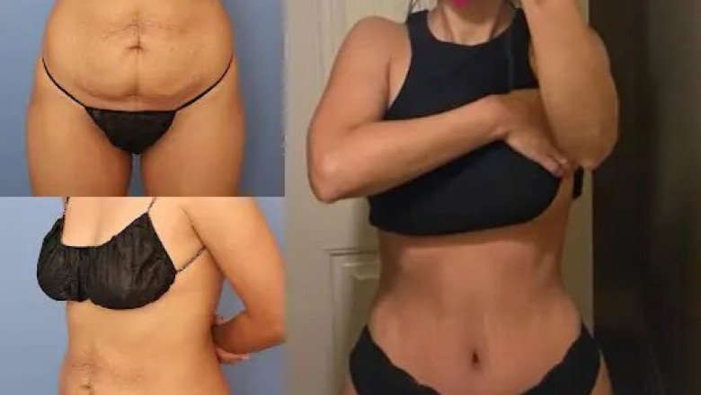 How Tummy Tuck in Dubai Can Transform Your Physique