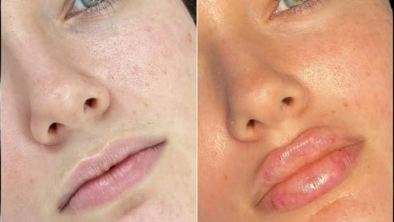 Achieve the Perfect Lip Shape with Russian Lip Fillers from the Best Plastic Surgeons in Dubai