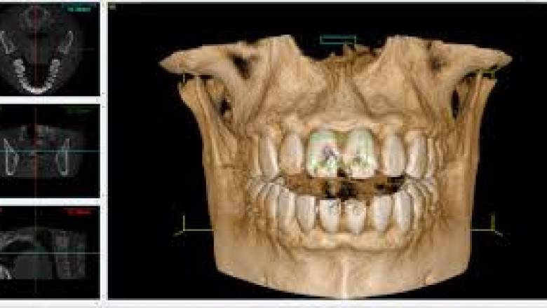 Digital Dentistry and the Expanding CBCT Imaging Market (2024–2032)