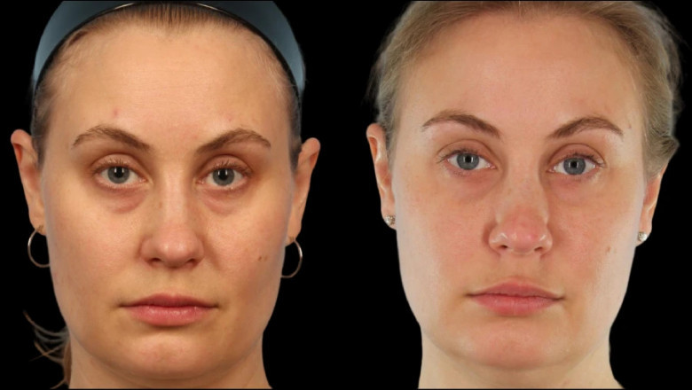 How the Best Plastic Surgeons in Dubai Use Under Eye Fillers to Correct Eye Bags