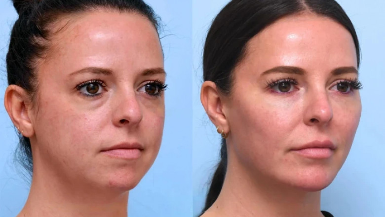 Thread Lift Treatments in Dubai: The Non-Surgical Face Lift Revolution