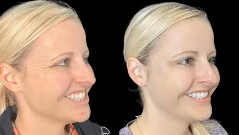 Experience Youthful Glow with the Best Doctors in Dubai for Botox