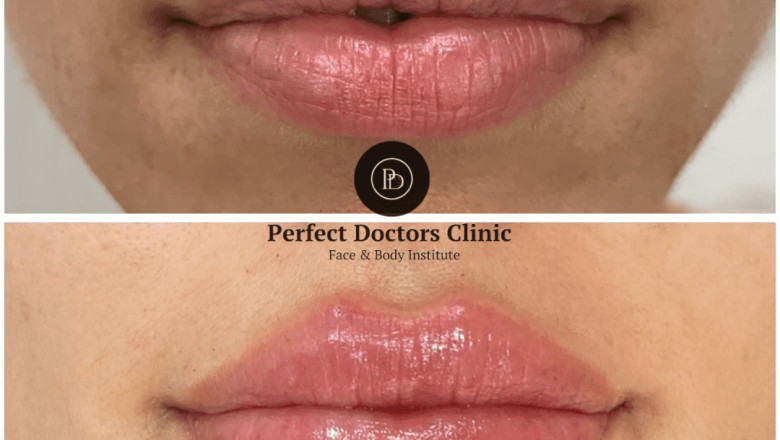 Juvederm and Post-Treatment Care: Best Doctors in dubai Insights