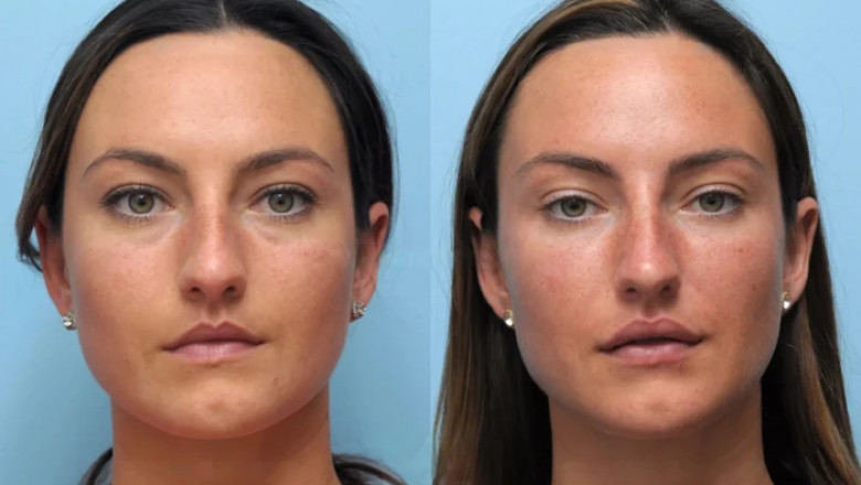 Where to Go for the Best Doctors in Dubai for Thread Lift Success
