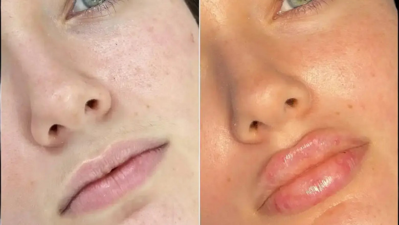 Why Everyone’s Talking About the Best Doctors in Dubai for Fillers