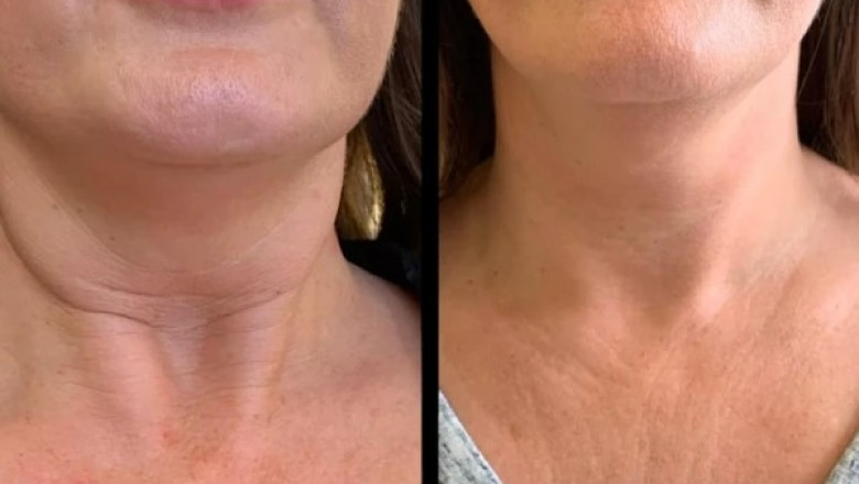 Level Up Skin with Profhilo at Best Aesthetic Clinic in dubai