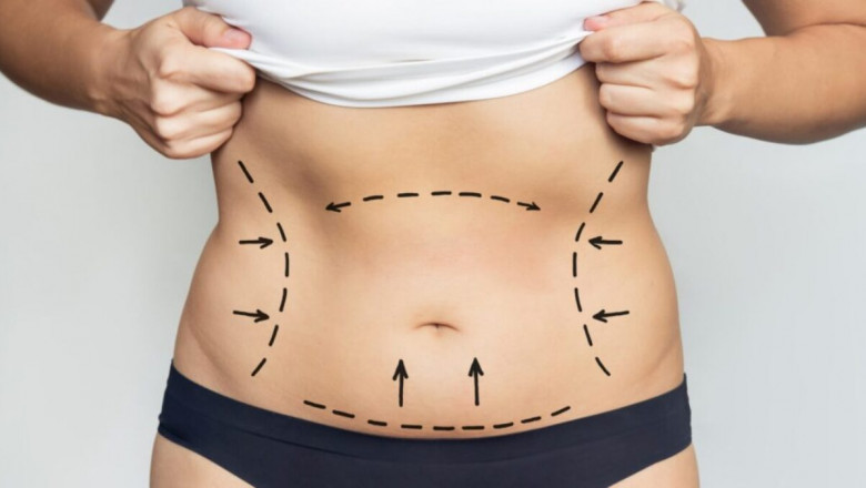 Embark on Your Liposuction Journey with Best Liposuction Surgeon in Dubai