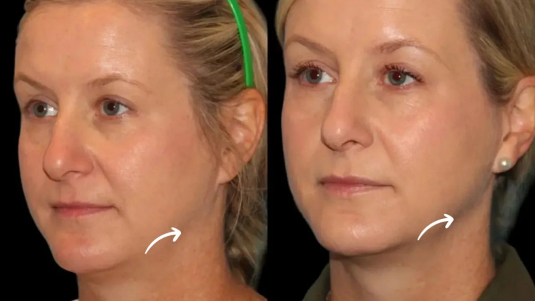 Soft Feminine Features via Sculptra Fillers at Dubai’s Best Aesthetic Clinics