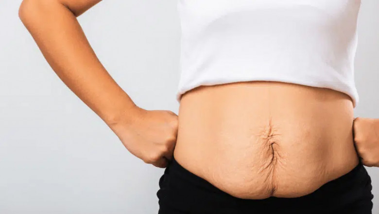 How Fat Transfer in Dubai Can Enhance Your Body Proportions Naturally