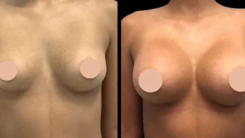 How Long Do Results Last After breast augmentation in Dubai