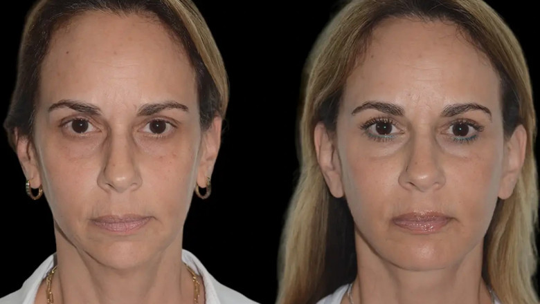 Celebrity-Approved Chin Fillers Treatments in Dubai