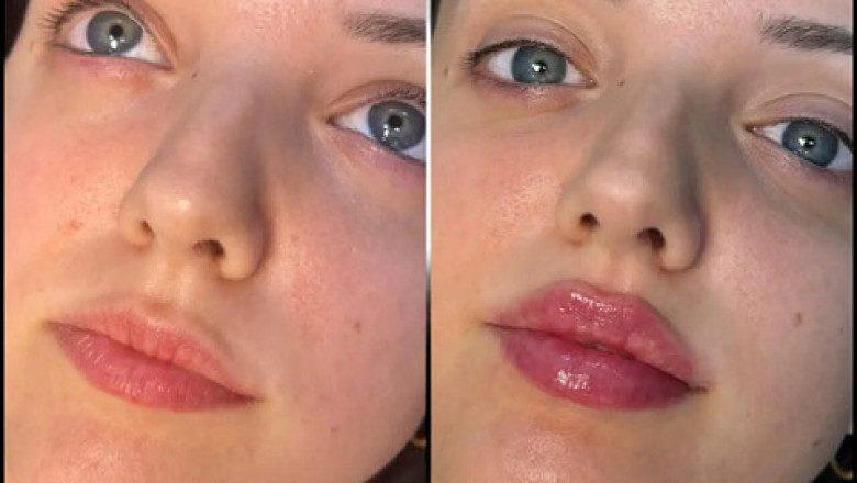 Fillers Treatments in Dubai: The Non-Surgical Anti-Aging Secret
