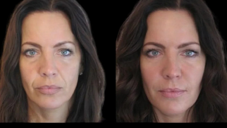 Jawline Fillers Treatments in Dubai: Tips for Maintaining Long-Lasting Results