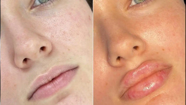Best Doctors in Dubai for Fillers for Long-Lasting Results