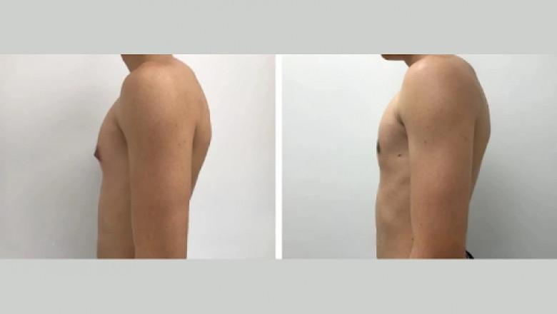 What Makes a Gynecomastia Surgeon the Best in Dubai?