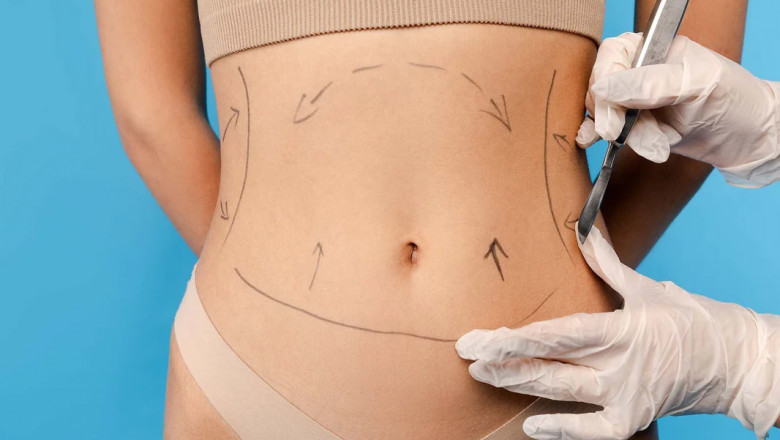 Benefits of Choosing Mini Tummy Tuck Dubai Over a Full Tummy Tuck