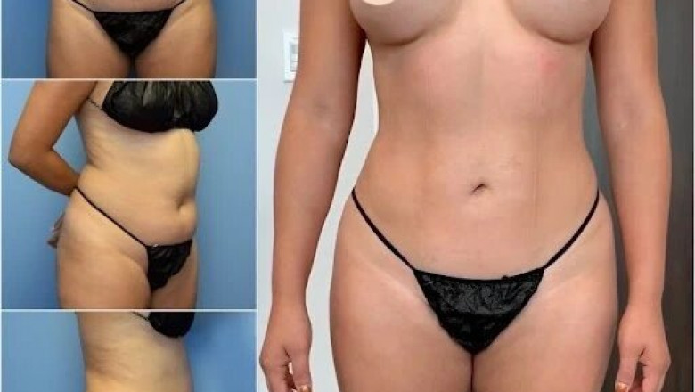 How the Best Body Contouring Surgeons in dubai Ensure Natural-Looking Results