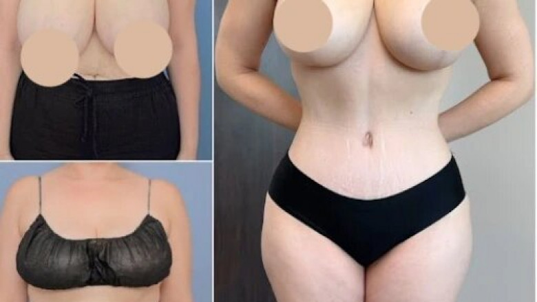 Why the Best Tummy Tuck Surgeons in dubai Offer More Than Just Surgery