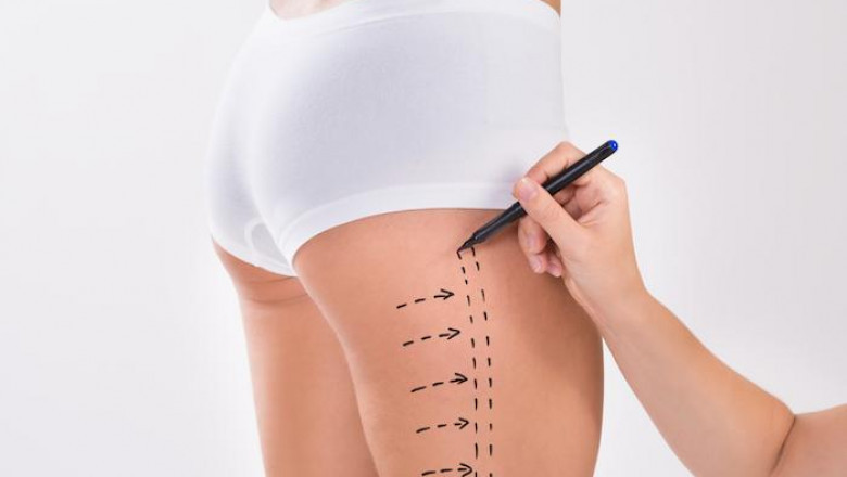 Sculpting Perfection with Best Liposuction Doctors in Dubai for Perfect Look