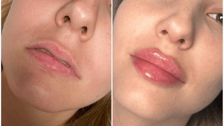 How to Choose the Best Aesthetic Clinics in dubai for Juvederm