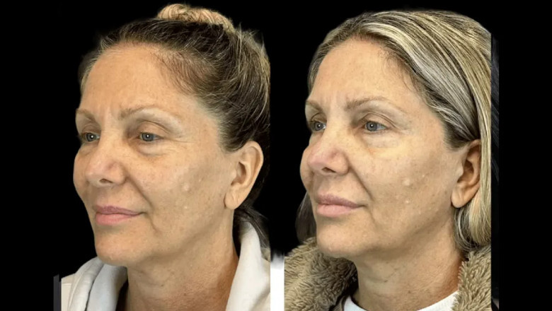 Natural Botox Results: Techniques Used by the Best Aesthetic Clinics in dubai