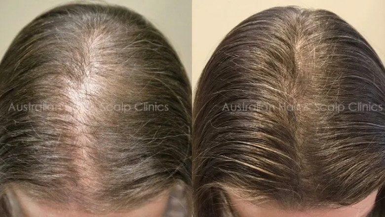 Achieve Natural Hair Regrowth Safely