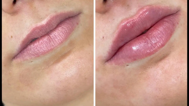 How to Ensure Your Russian Lip Fillers in Dubai Look Natural and Beautiful