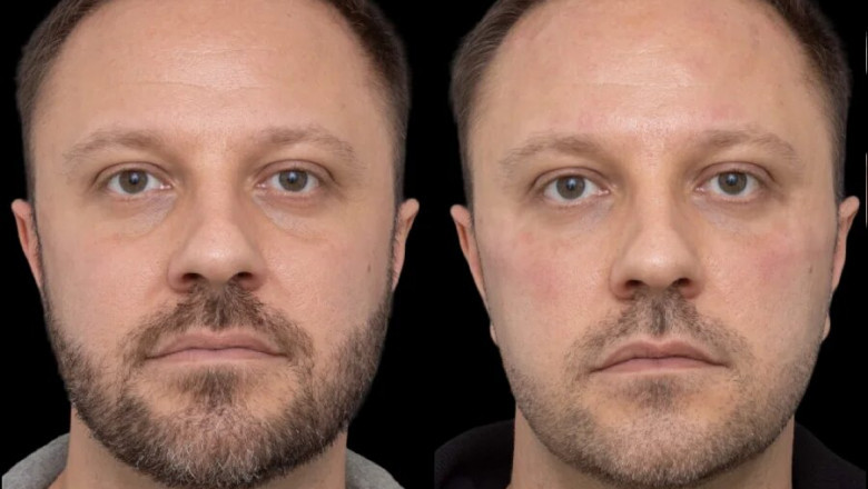 How to Find Affordable Under Eye Fillers in Dubai