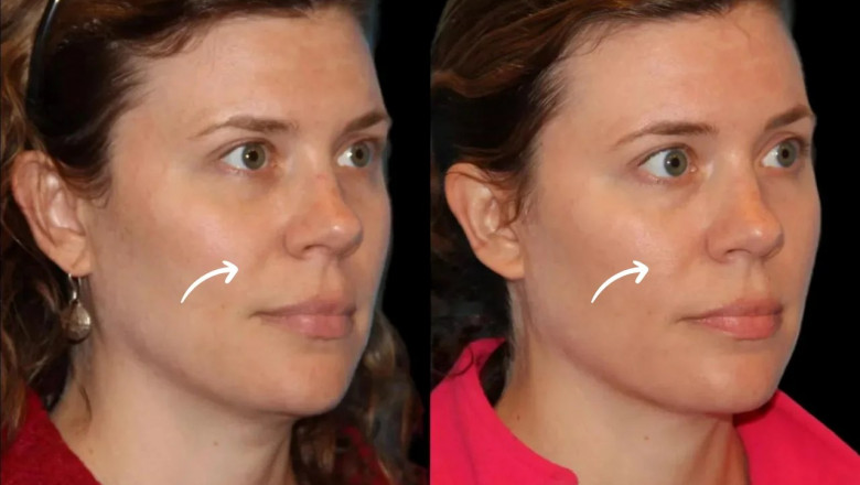 Virtual Consultations for Sculptra Fillers Available in Dubai