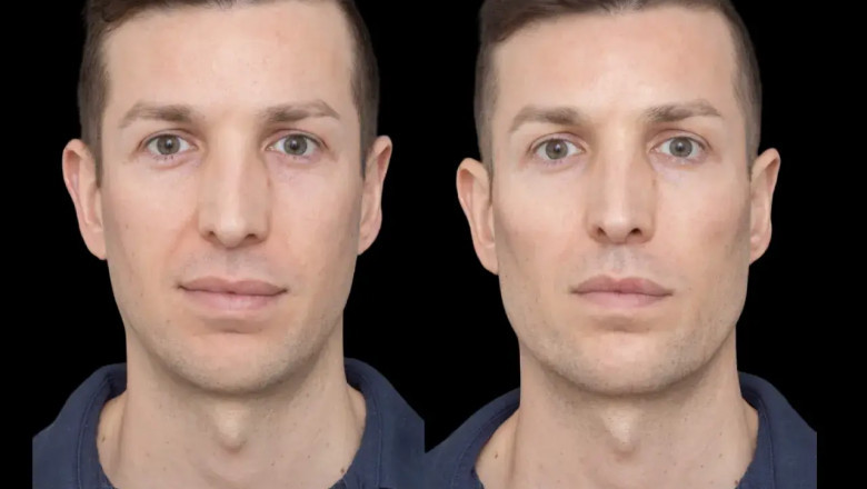 What to Look for in a Specialist for Cheek Fillers in Dubai
