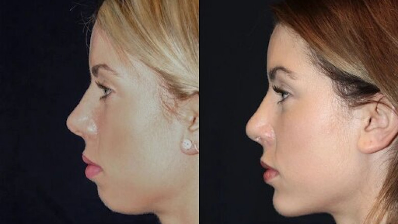 Best Plastic Surgeons in dubai for Chin Fillers: Treatment Duration and Expectations
