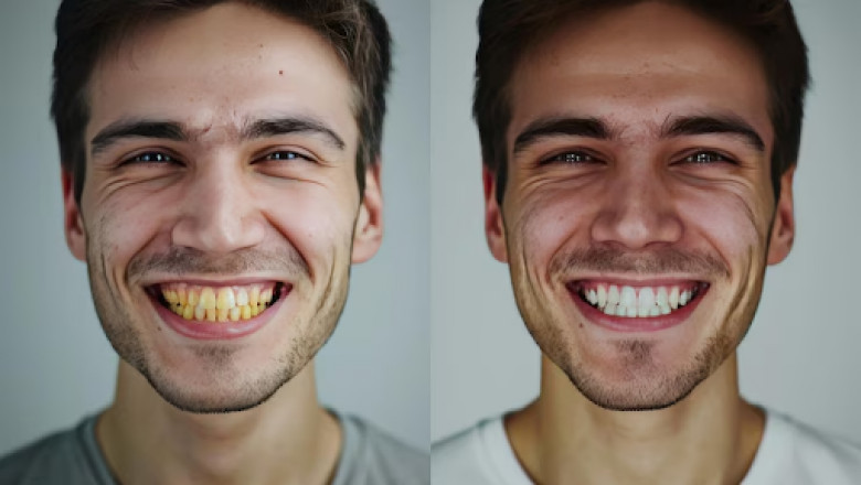 Dental Bonding Before and After: Instantly Transform Your Smile