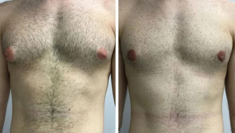 Latest Trends in Gynecomastia in Dubai