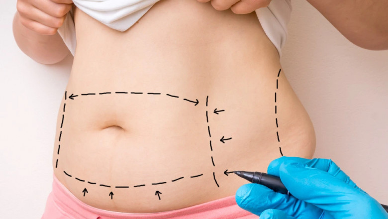 The Benefits of Mini Tummy Tuck Surgery in Dubai: Is It Right for You?