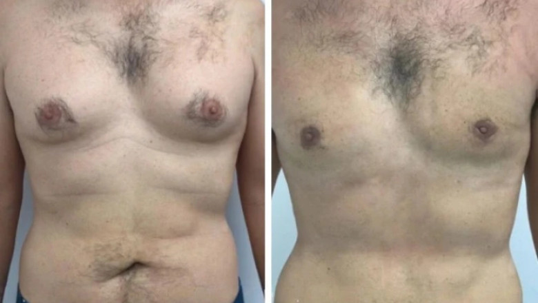 The Cost of Gynecomastia in Dubai: Breaking Down the Numbers