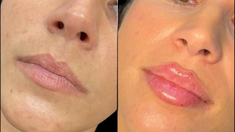 Best Aesthetic Clinics in Dubai for Fillers with Great Results