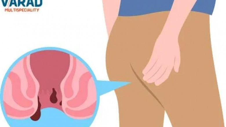 Expert Piles Treatment in Pune at Varad Multispeciality Hospital, Punawale