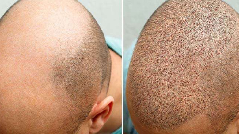 DHI Hair Restoration Albania: De Slimme Oplossing voor Haarverlies in het Verenigd Koninkrijk