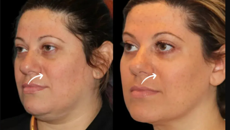 The Impact of “Filler Fatigue” on Sculptra Fillers in Dubai Trends