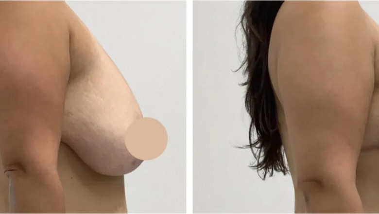 Best Doctors in Dubai Discuss Breast Lift in Dubai vs. Other Cosmetic Options