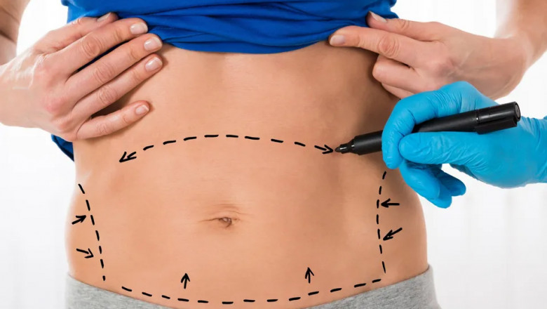Best Tummy Tuck Surgeon in Dubai: What You Should Know Before Your Surgery