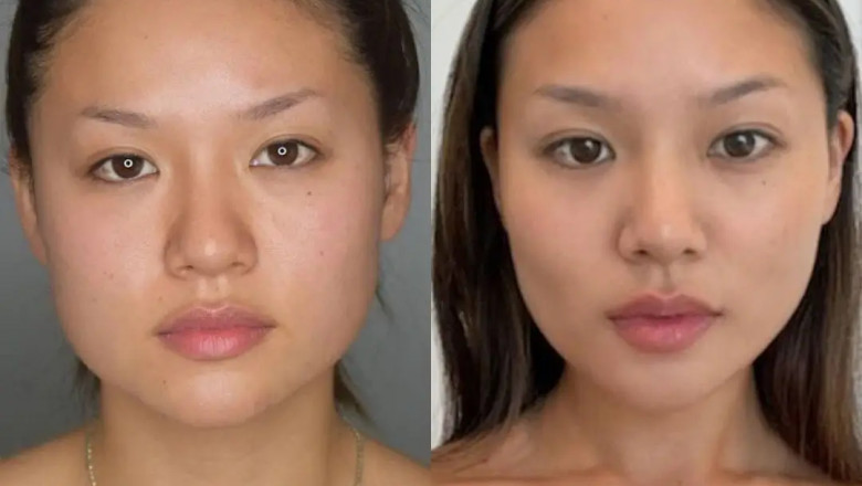 How Skin Type Affects Buccal fat removal in Dubai Outcomes