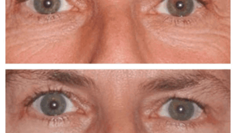 How soon can I wear makeup after Eye bag removal in Dubai?