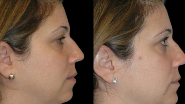 What Is the Downtime After Double chin removal in Dubai?