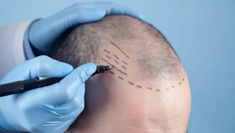 Regrow with Confidence: The Ultimate Guide to FUE Hair Transplant in Lahore