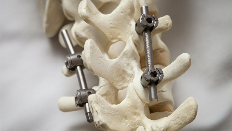 Spinal Osteosynthesis Units Market Size and Growth Analysis