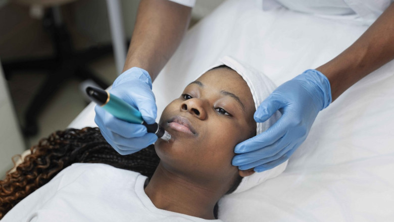 Microneedling Mississauga