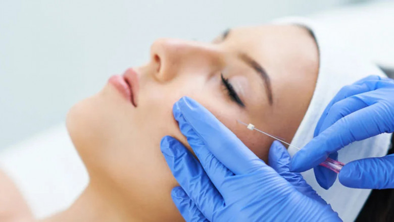 Rejuvenate Your Look: Exploring the Benefits of Thread Lifts