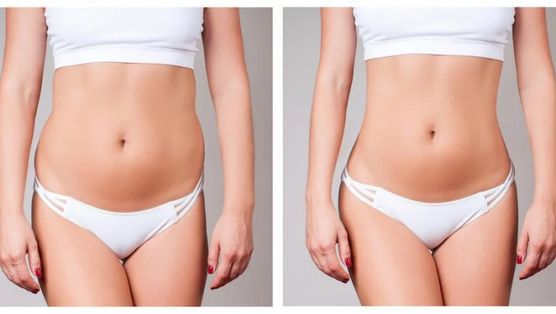 Fat Transfer in Dubai: What to Expect Before, During, and After Your Procedure